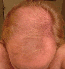 FOLIGAIN Minoxidil 5% Hair Regrowth Treatment For Men 3 Month Supply - FOLIGAIN EUROPE